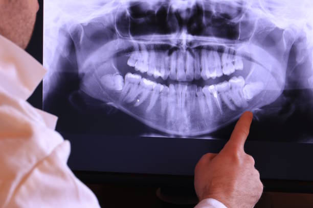 Best Emergency Wisdom Teeth Removal in Oxoboxo River, CT