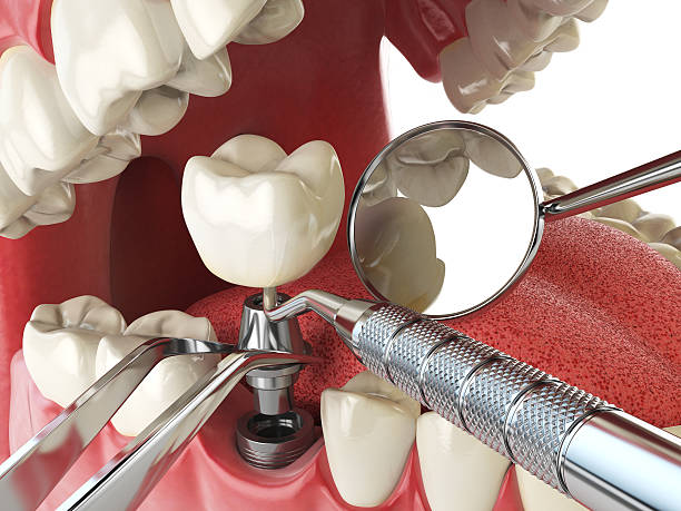 Best Emergency Root Canal Treatment in Oxoboxo River, CT